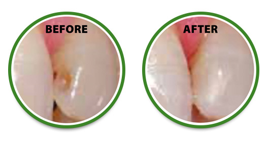 oil pulling before and after cavities
