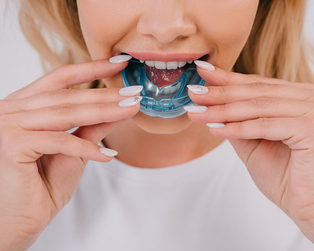 Are Mouthguards Important?