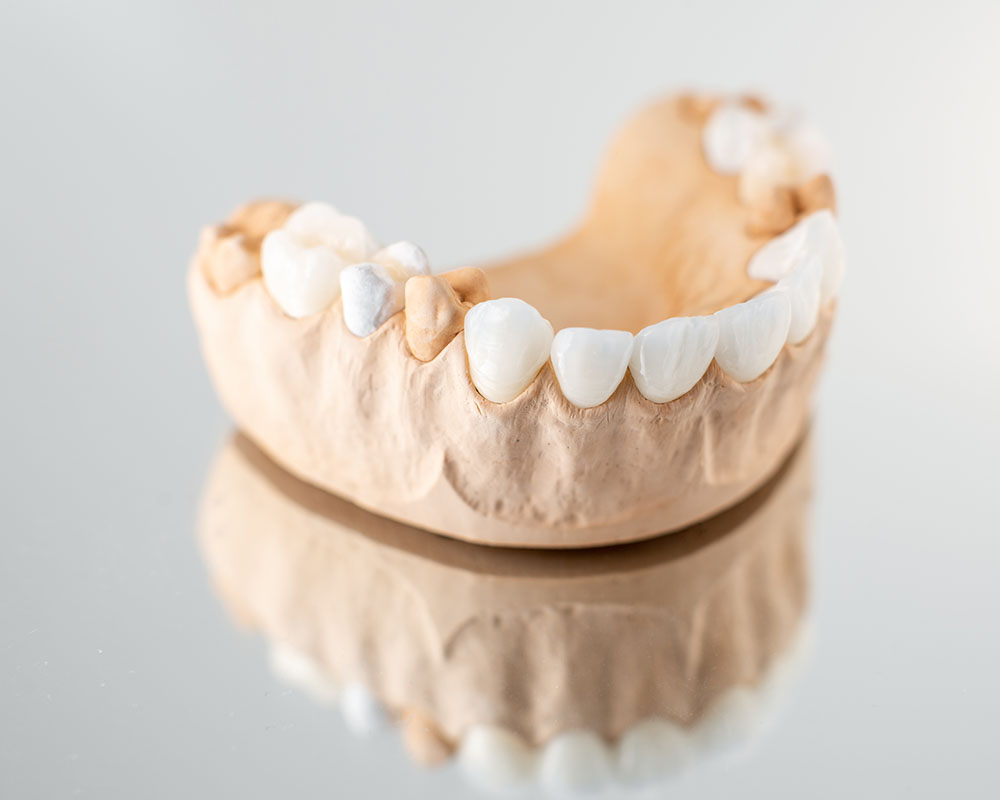 Restoring Teeth Without Metal: What Are Zirconia Crowns, Onlays, Inlays, and Composite Fillings?