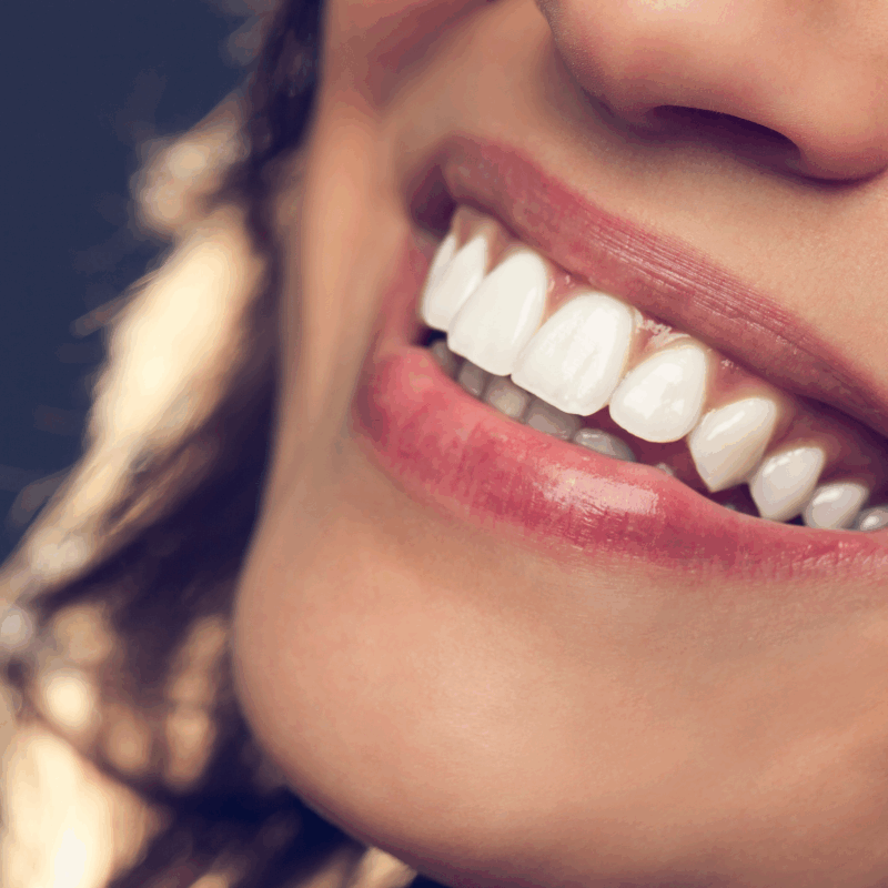 Discover Prepless Veneers: Natural Smile Enhancement Without Drilling