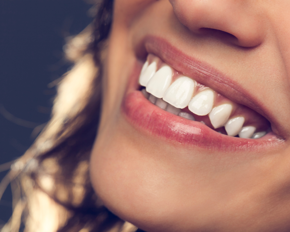What Are Prepless Veneers, and Are They Right for You?